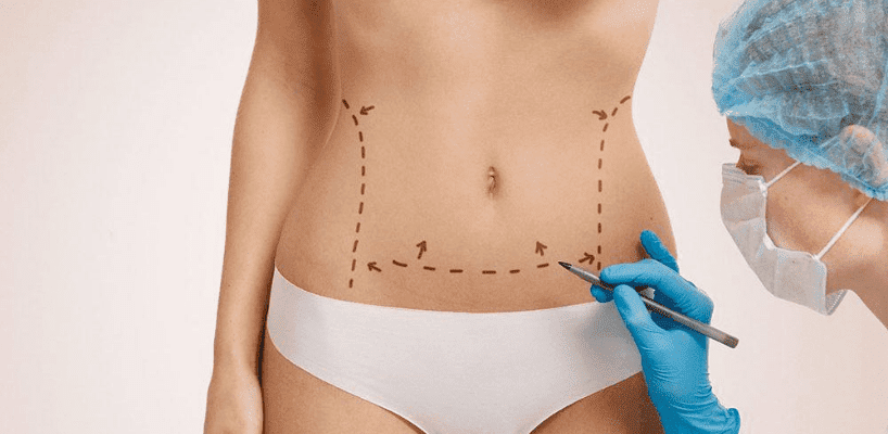 abdominoplastie