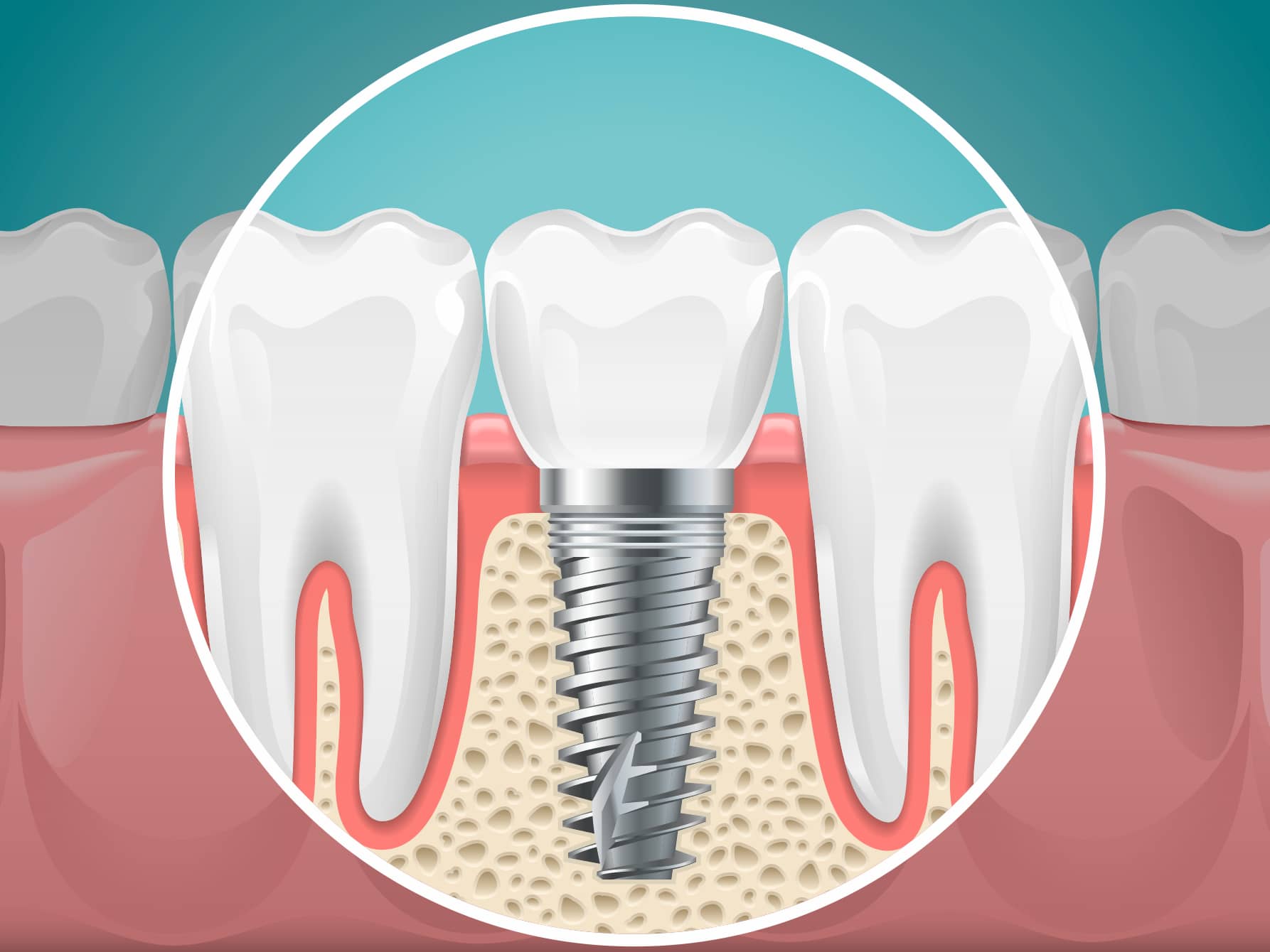 implants_dentaires