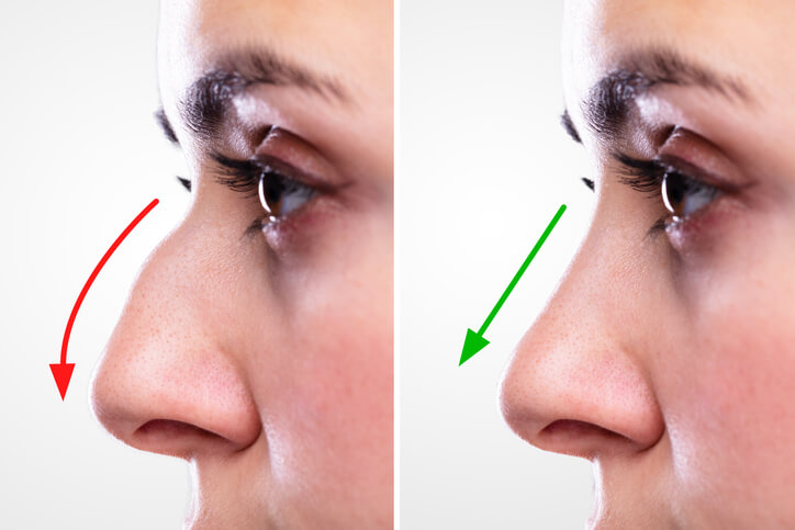 rhinoplastie-turquie