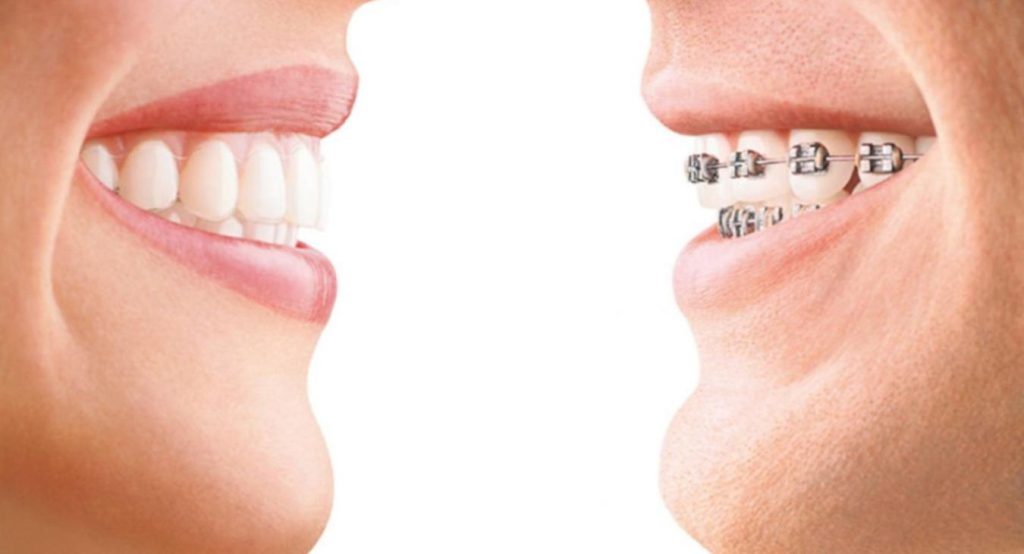 orthodontie-classique-vs-invisalign