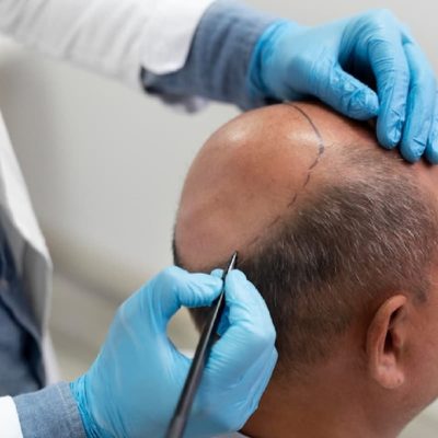 hair-transplant-turquie